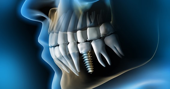 Reasons Why You Should Go For Dental implants. 