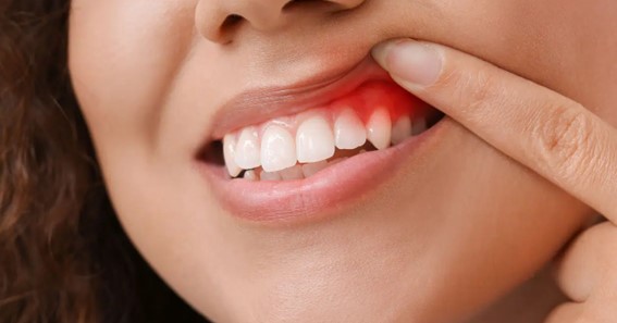 How is Gum Disease Normally Treated?
