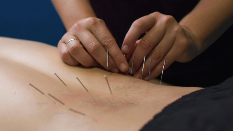 What Is Dry Needling In Physical Therapy