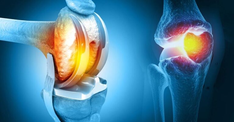 Knee Joint Replacement: Procedure & Potential Risks - Askcorran